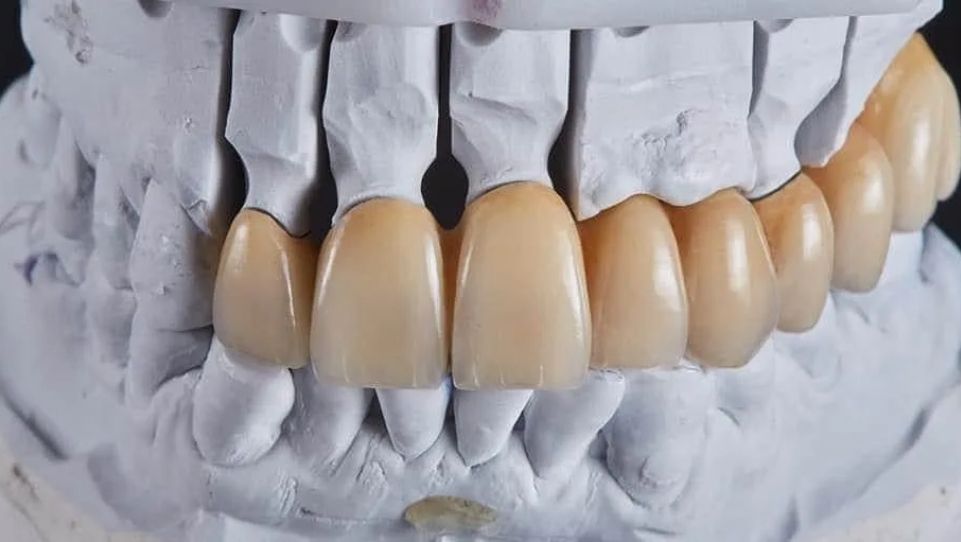 Full Mouth Rehabilitation in Pune