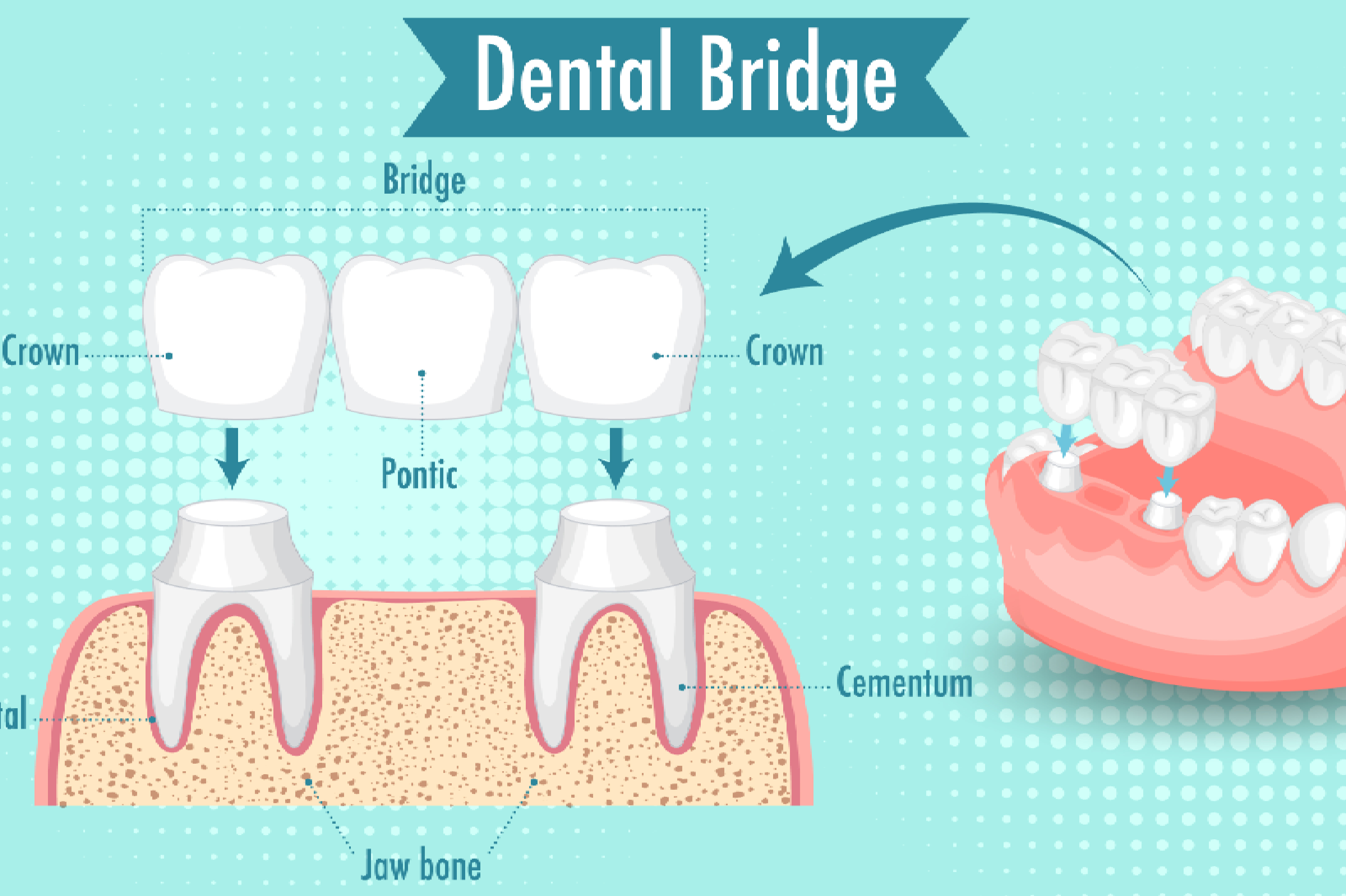 Crowns and bridges in pune