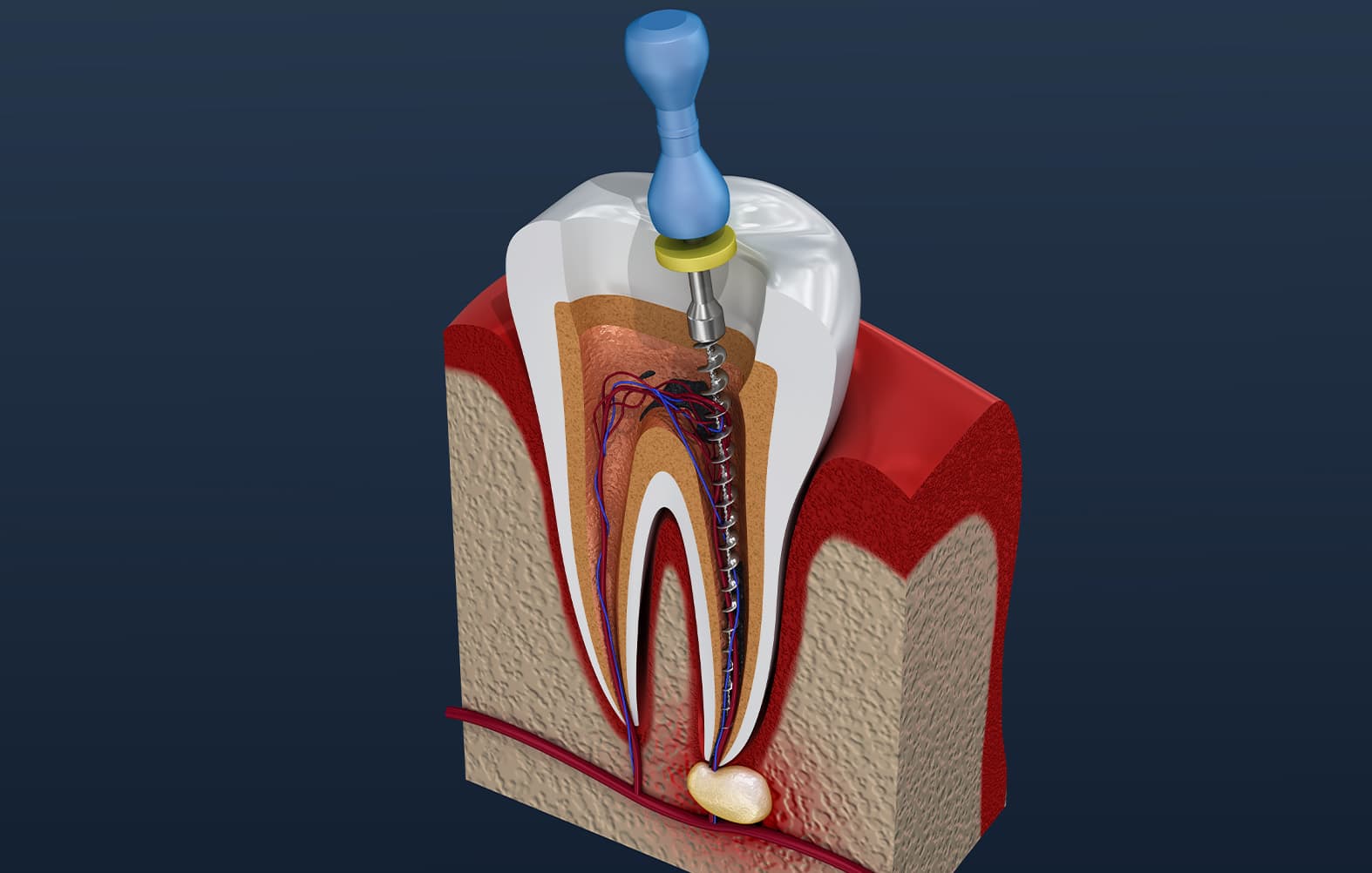 Tooth Extraction in Pune